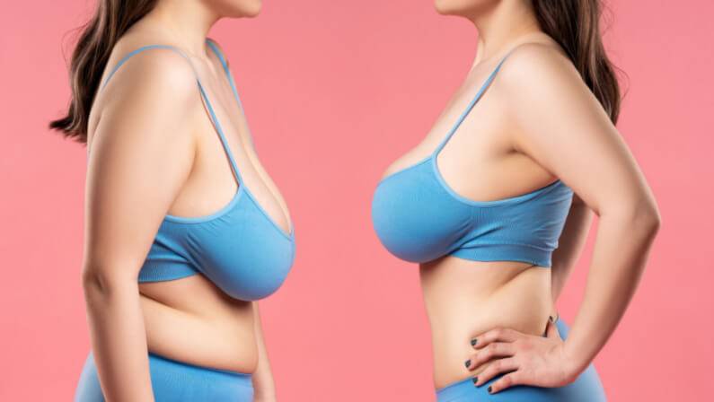 reasons for breast reduction surgery