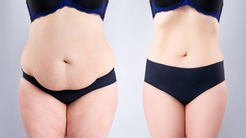 what to expect with liposuction