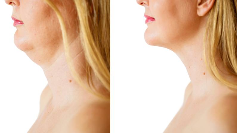 neck lift surgery before and after