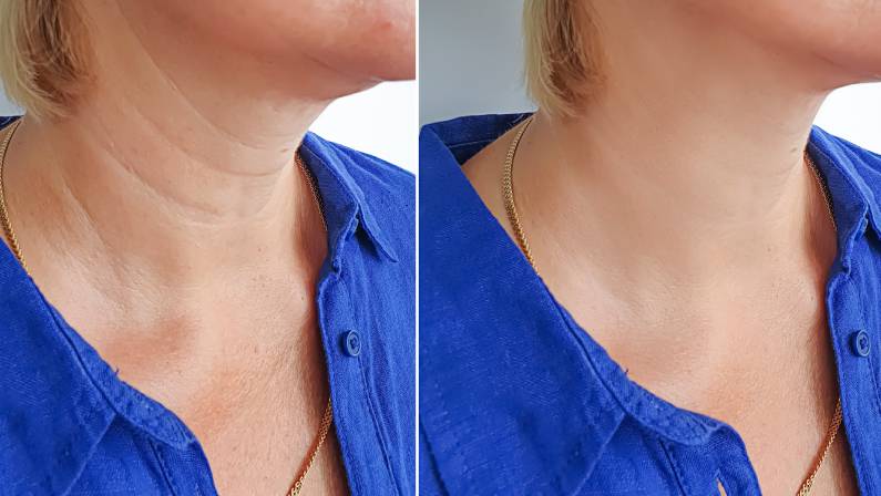 before and after neck cosmetic surgery