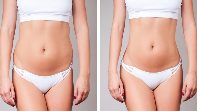 Female body before and after liposuction.