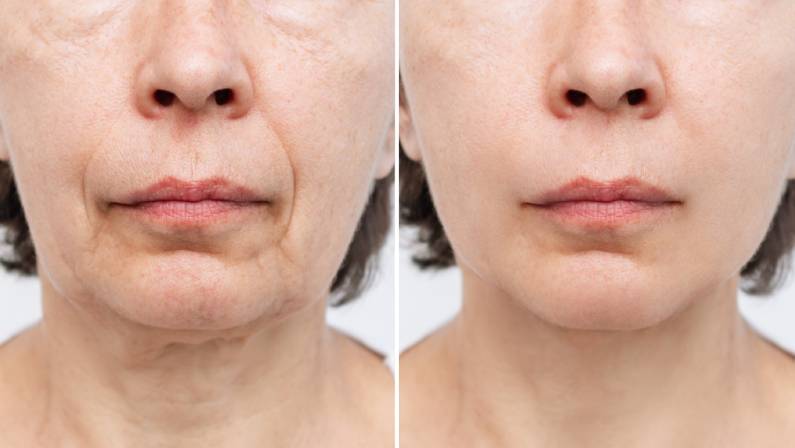 how-long-does-it-take-to-recover-from-a-facelift