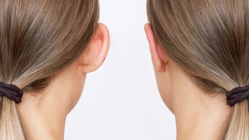 woman’s head before and after otoplasty