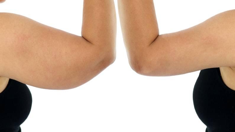 Brachioplasty or Upper-Arm Lift plastic surgery in Asian woman.