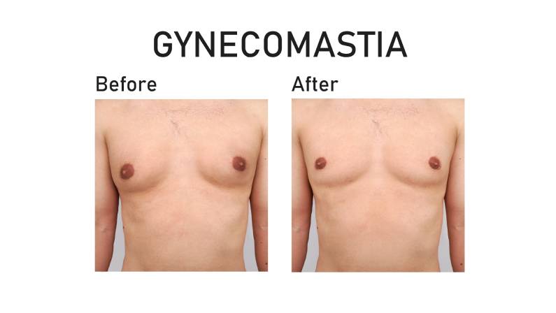 Gynecomastia. Before and after surgery