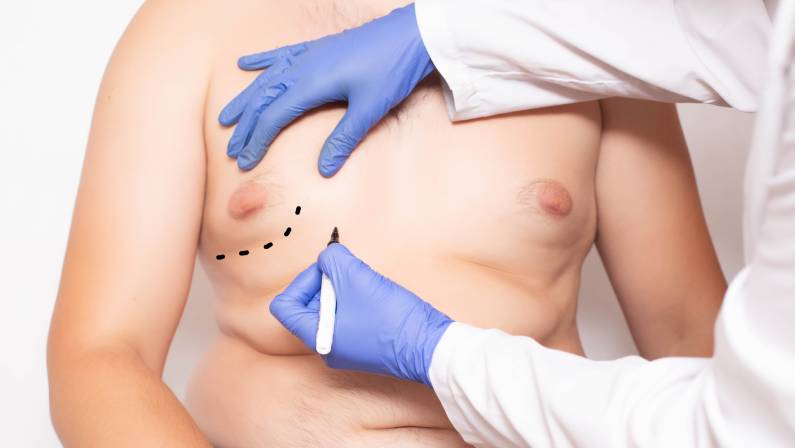 Doctor plastic surgeon preparation before surgery to reduce breasts in men, gynecomastia