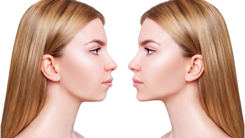 What You Need To Know About Jaw Contouring Surgery: Definition, Risks, Costs, Preparation