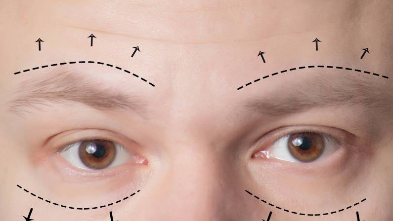 Plastic surgery of eyebrows in men.