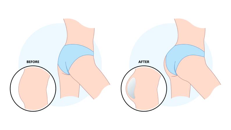 buttock enhancement augment surgery graft Brazilian Butt lift