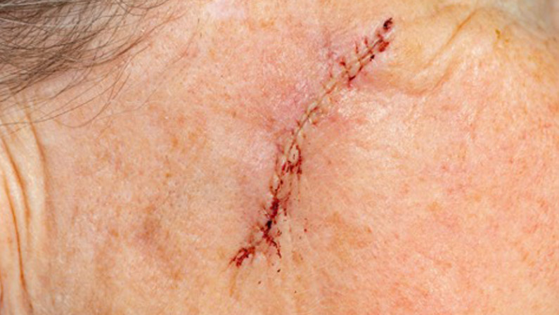 Mohs Reconstructive Surgery: Restoring Confidence After Skin Cancer