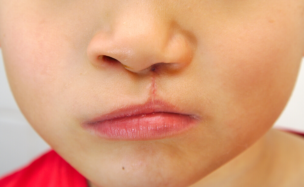 Boy showing a unilateral cleft lip repaired 
