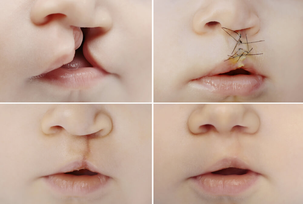 Closeup on lips of baby with lip and palate cleft before and after surgery. 