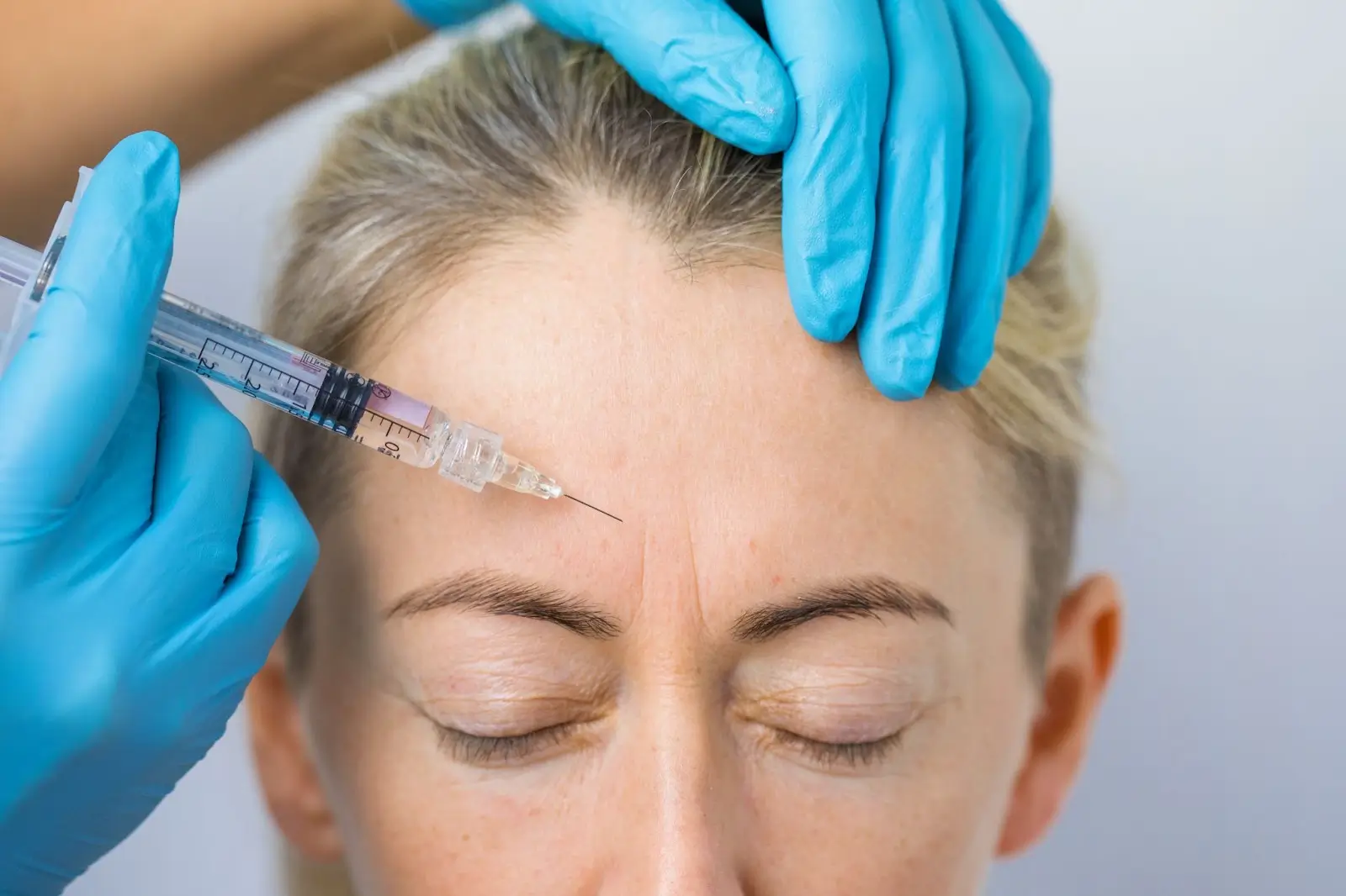 Understanding Botox Forehead Injection Sites