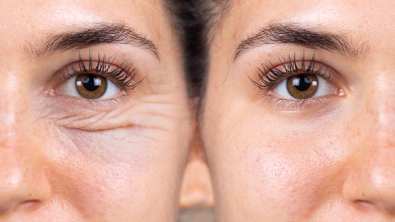 How Much Is Blepharoplasty Surgery